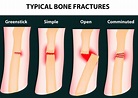 kinds of bone fractures