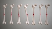 Fractures: Types, Symptoms, Causes and Treatment - Scientific Animations