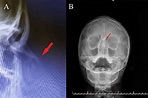 Radiographic images of nasal fracture, (A) Lateral nasal radiography ...