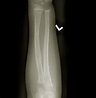 Greenstick Fracture - Pictures, Treatment, Symptoms, Healing Time ...