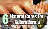6 Natural Cures For Scleroderma – Natural Home Remedies & Supplements