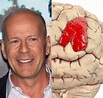 Bruce Willis se retira tras diagnóstico de afasia ¿es tratable?