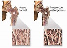 Osteoporosis: huesos frágiles - Infoteca en Saludisima
