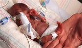 Cada vez mais bebês prematuros extremos sobrevivem - Sou Mamãe