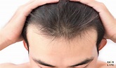 M型禿頭的預兆…！？M型禿的成因及預防方法大公開 | 髮樂活