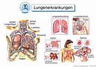 Lungenschonende Beatmung: Risiko von Komplikationen während und nach ...
