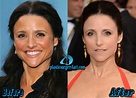 Julia Louis-Dreyfus Plastic Surgery Before And After Photos - Plastic ...