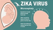 Zika and Pregnancy: Symptoms, Effects and Prevention