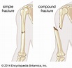 Compound fracture | pathology | Britannica