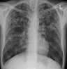 Miliary tuberculosis - Wikipedia