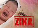 Zika Virus Causes Brain Defects in Babies: CDC