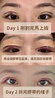 #分享 #台南 自然系割雙眼皮12天快速消腫 - 醫美板 | Dcard
