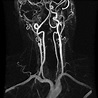 ICA occlusion with collateral circulation | Radiology Case ...
