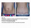 Tummy Tuck Surgery Before & After Photos » UF Health Plastic Surgery ...