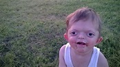 Mom Responds To Cruel Meme About Her Son With Craniofacial Disorder ...