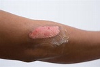 Second-degree burn: Causes, symptoms, and treatment