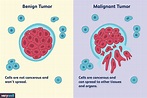 Differences Between a Malignant and Benign Tumor