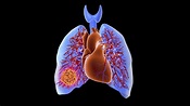 Lungenerkrankungen: Übersicht der Krankheiten