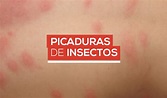 Picaduras de insectos – Clínica Pueyrredon