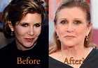Carrie Fisher Plastic Surgery: Before and After Rumor