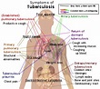 Tuberculose — Wikipédia