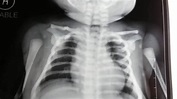 Clavicle fracture in a newborn rarely seen - YouTube