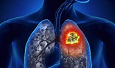 Cáncer de pulmón, ante grandes retos en diagnóstico, | BajaPress