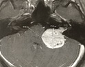 Cureus | Large Vestibular Schwannoma: A Two-Stage Surgery