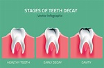 The Stages of Tooth Decay - Orthodontics Limited