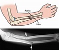 Adult Forearm Fractures - OrthoInfo - AAOS