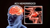 Enfermedad cerebrovascular hemorrágica: qué es y su fisiopatología