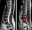 MRI Lumbar spine scan sagittal view Lumbosacral spine has straightening ...