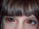 Red Eye | Jessica's eyes after the eye surgery | David C. Brewster | Flickr