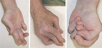 Striatal deformities of the hand and foot in Parkinson's disease - The ...