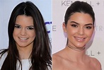 Kendall Jenner Before and After Plastic Surgery