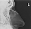 Nasal Bone Fracture- Grey Zone - Sumer's Radiology Blog