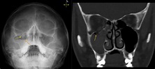 Orbital blowout fracture - Radiology at St. Vincent's University Hospital