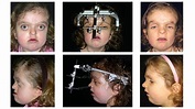 Surgical Management of Craniofacial Conditions | Children's Hospital of ...