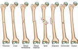 Distal Femoral Fractures A Comparison Between Single Lateral Plate ...