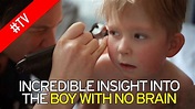 Boy with 'no brain' stuns doctors as he learns to count and attends ...
