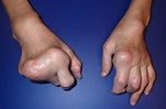 Deformities of the Hand | Hand Surgery Associates