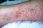 Rocky Mountain Spotted Fever (RMSF) Its Treatment with Ayurveda