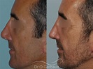Photos de rhinoplastie fonctionnelle / septoplastie, avant et après