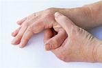 Comprehensive Assessment of Hand Deformities in RA: Useful Tool for ...