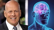 ¿Qué es la afasia? El trastorno que “obliga” a Bruce Willis a alejarse ...
