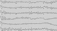 Image: Kammerflimmern (EKG) - MSD Manual Profi-Ausgabe