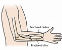 Forearm Fractures in Children - Types and Treatments - OrthoInfo - AAOS