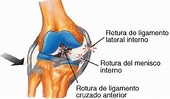 Tríada: la lesión de rodilla que más afecta a los deportistas - MENzig