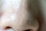 如何減少鼻頭粉刺、皮脂管絲？醫教日常簡易撇步｜皮膚｜該看哪科｜元氣網