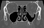 Orbital Blow-Out Fractures – Core EM